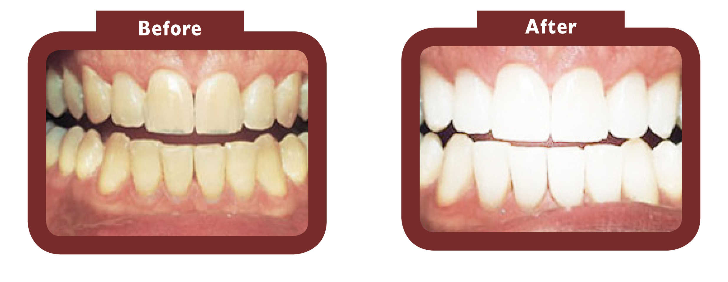 See LA Teeth Whitening before and after results. Contact our team today! Rushden
