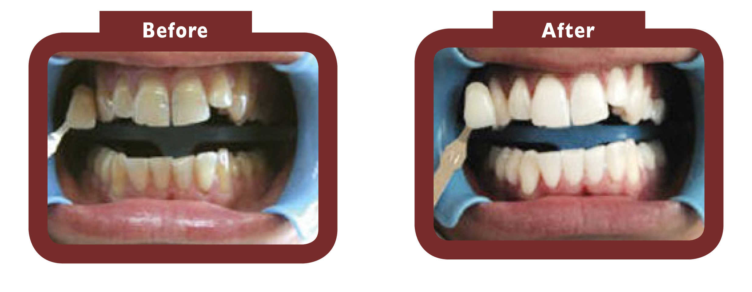 Before and after teeth whitening Rushden - LA TEETH Rushden