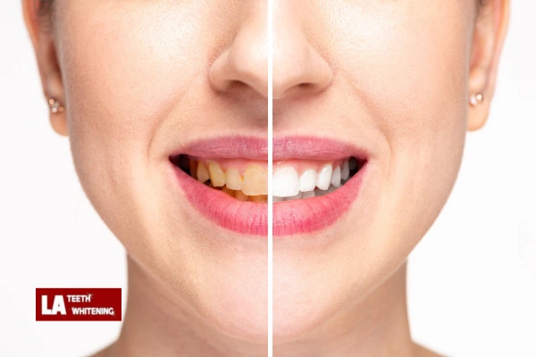 About Us At LA Teeth Whitening Rushden Contact us today! Rushden