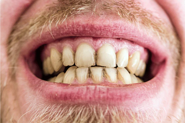 Why Do Lifestyle Habits Like Coffee, Wine, and Smoking Shorten Whitening Results Rushden