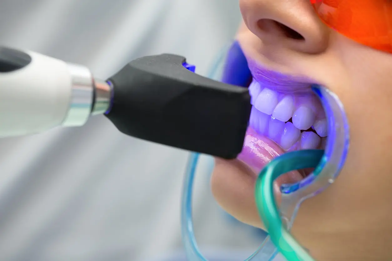 How Does LA Teeth Whitening Combine Safety, Comfort, and Professional Results Rushden