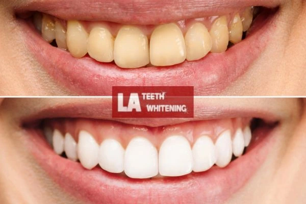 Before and after results - smokers stained teeth results! Rushden