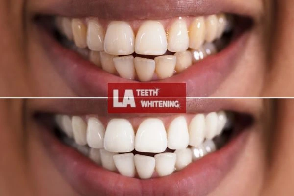 Fast and effective whitening results in one hour. Contact LA Teeth Whitening Rushden to book online Rushden