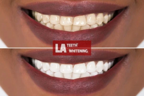 Brighter and white smile - before and after results Rushden book online today! Rushden