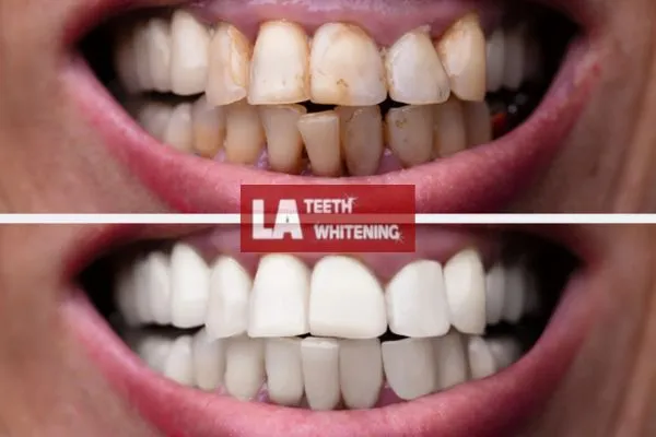 Customer results from LA Teeth Whitening Rushden Book today. Rushden