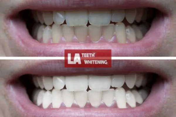 Mens before and after of teeth whitening results Rushden Rushden