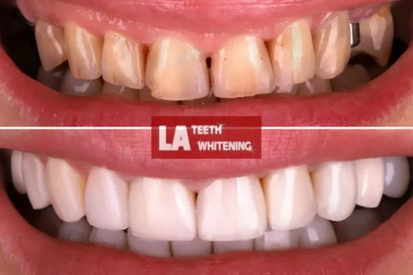 yellow teeth from coffee drinking before and after laser teeth whitening results Rushden