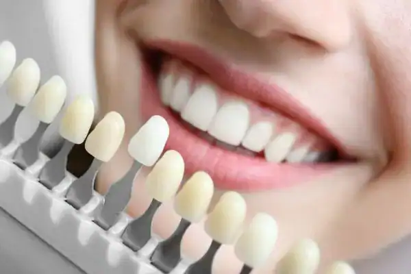 laser whitening Faqs Rushden